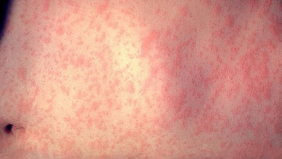 DGS diz que infetados com sarampo têm forma ligeira e modificada da doença e não a transmitem
