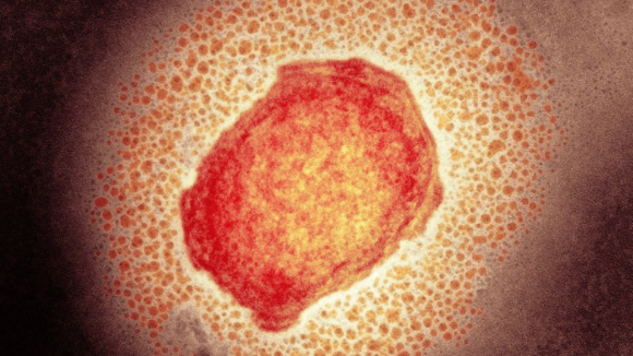 EXCLUSIVO.
Vírus 'monkeypox' chega a Portugal. DGS confirma pelo menos cinco casos e 20 suspeitos