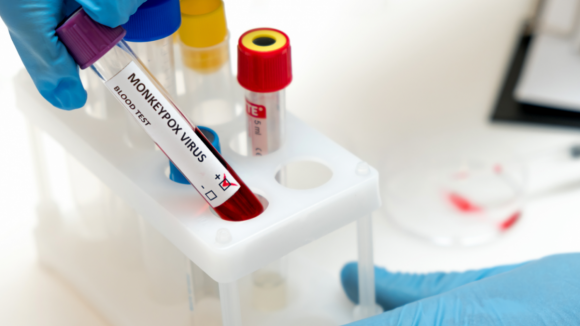 Monkeypox: Portugal recebe vacinas para contactos até ao final do mês
