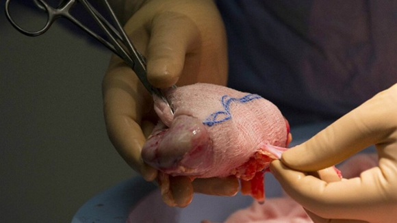 Rim de porco continua a funcionar em humano mais de um mês depois do transplante