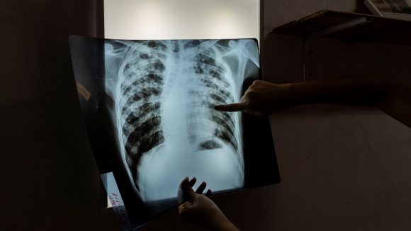 Novos casos de tuberculose batem recorde de 7,5 milhões em 2022